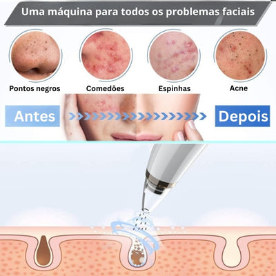 Limpador de Poros 5 em 1