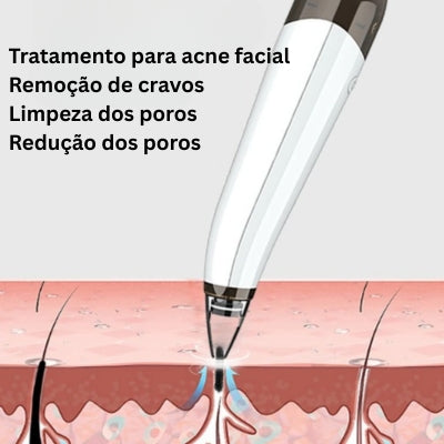Limpador de Poros 5 em 1